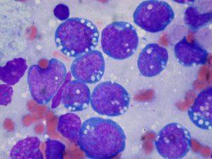 Burkitt lymphoma, touch prep, Wright stain